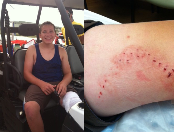 12 Year Old Boy From Utah Bitten By Shark In South Carolina